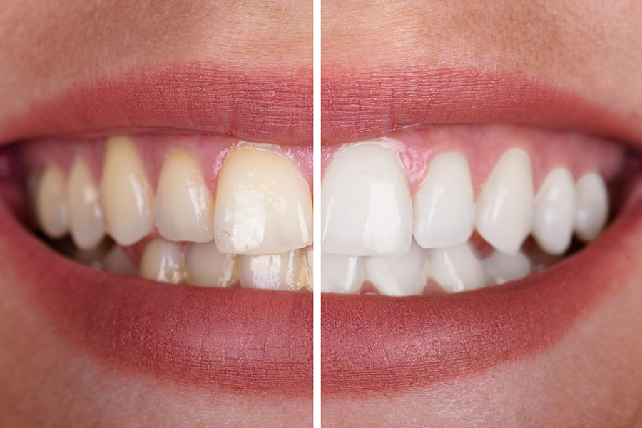 teeth whitening patient Riyo Dental