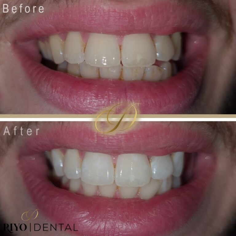 Teeth Whitening Manchester, Stretford 5* Experts Stunning