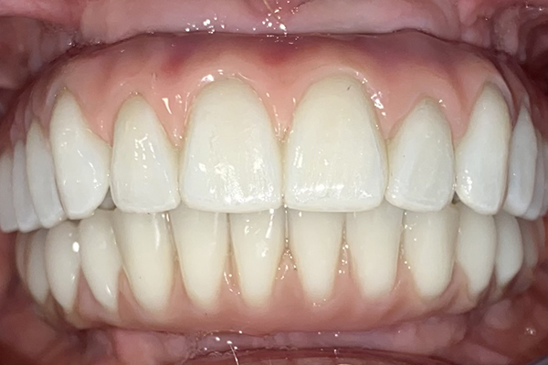 Low price dental implant results in Manchester