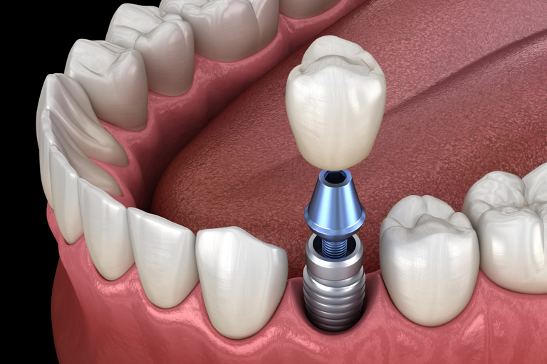 Low cost dental implants Manchester