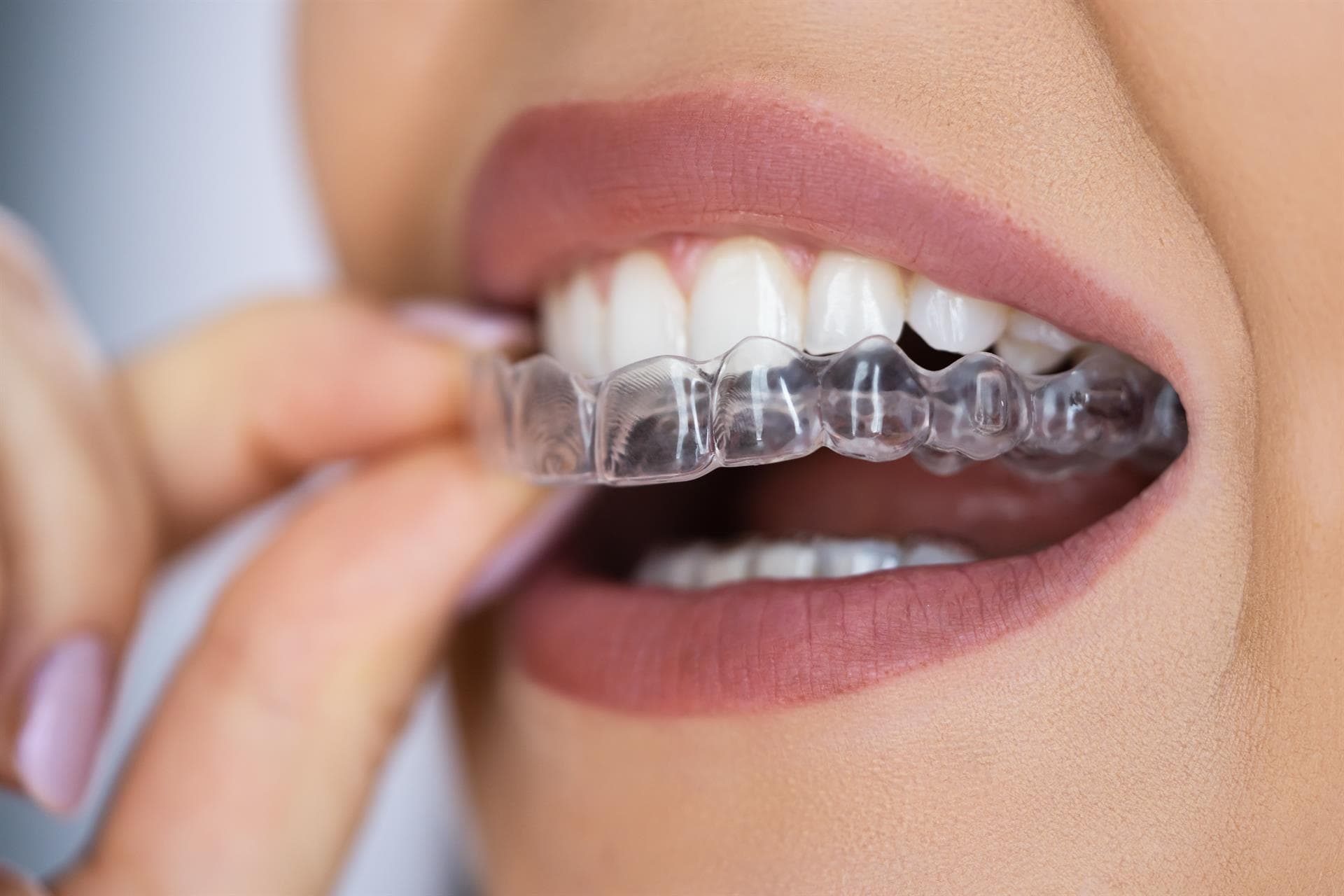 A person placing a clear plastic dental aligner over their upper teeth