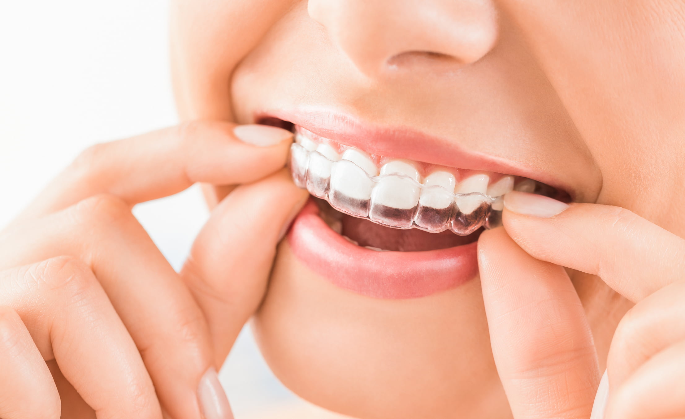 Woman fitting Invisalign aligner onto her teeth