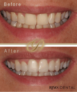 Before and after image demonstrating the transformative effect of composite bonding