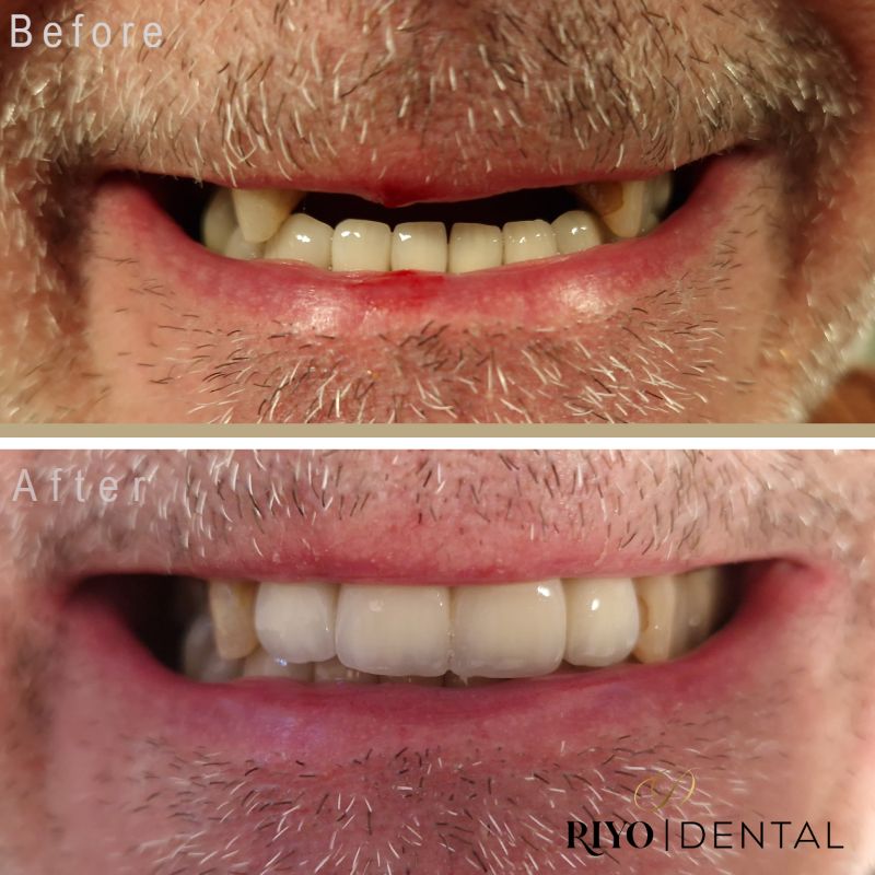 Before and after images of a male patient showing the results of dental implant treatment at Riyo Dental