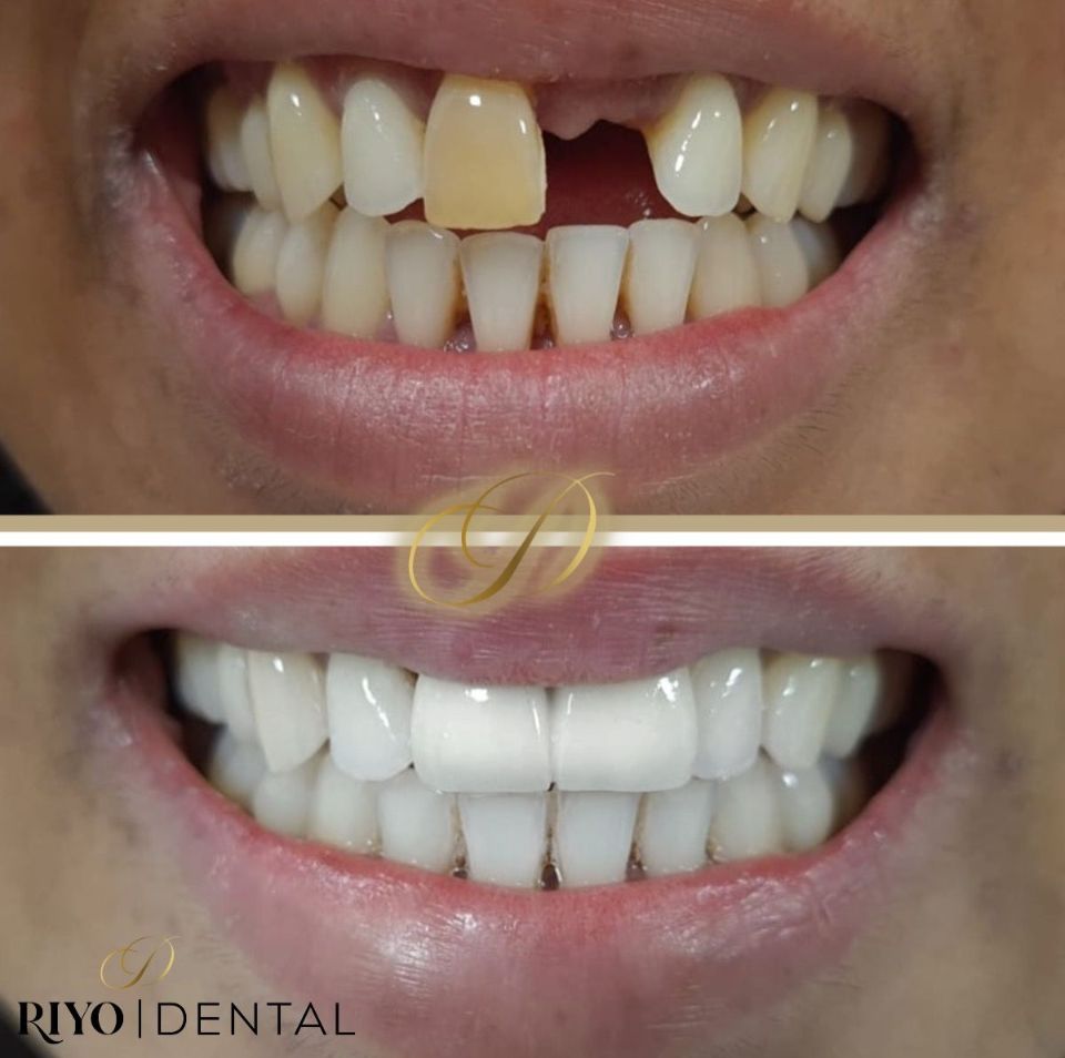Before and after images of a male patient showcasing the results of a dental bridge treatment at Riyo Dental