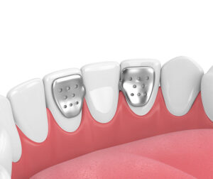 Diagram illustrating a resin-bonded dental bridge with metal wings bonded to adjacent teeth