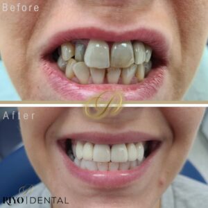 Before and after image of a patient’s smile makeover at Riyo Dental