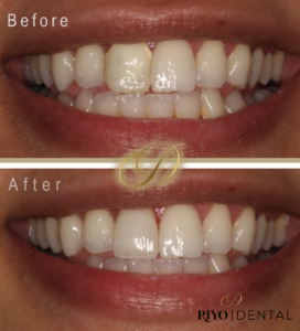 Before & After Crown Image