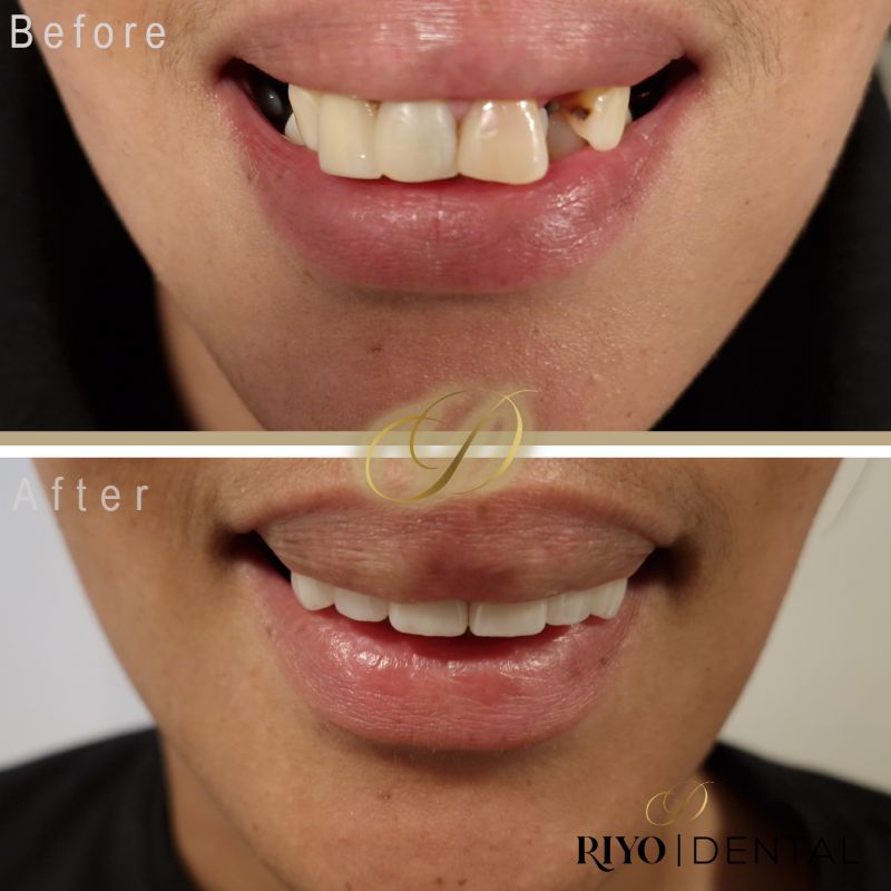 Before and after dental implant treatment showing restored smile and improved teeth appearance.